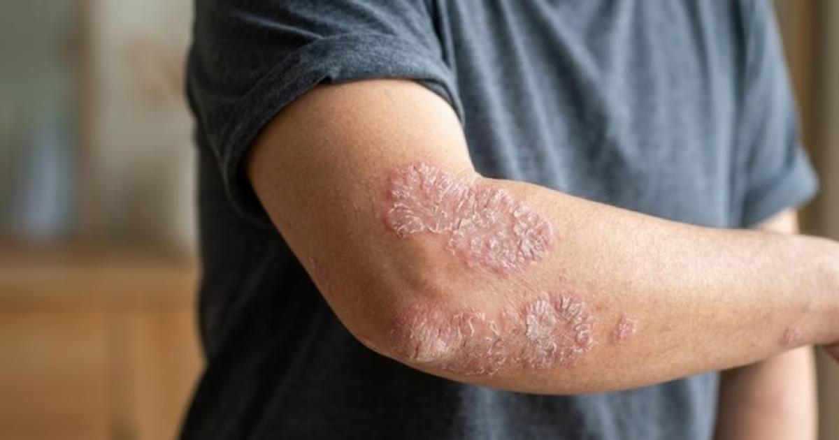 Psoriasis- tener poca parte de la piel afectada no siempre significa una enfermedad leve