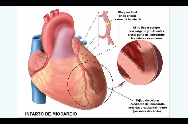 Qué es el infarto agudo de miocardio o ataque al corazón - El infarto