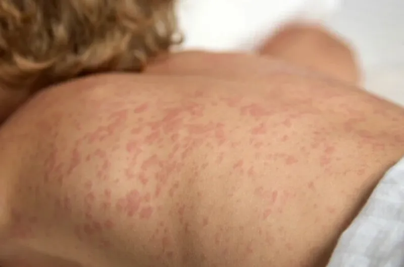 Aumenta la alerta epidemiológica por sarampión tras caso confirmado en Entre Ríos